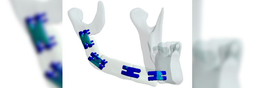 A graphic showing a human jaw bone held together by 3D surgical plates.