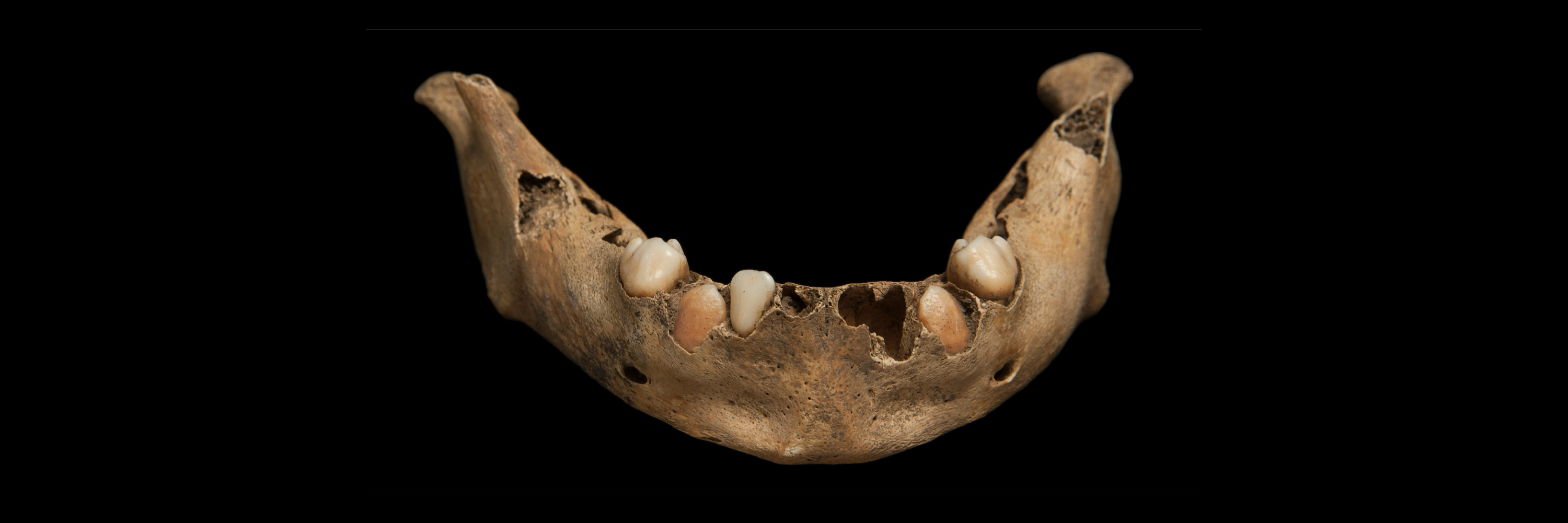 Tooth enamel web news